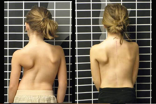 Scoliosis